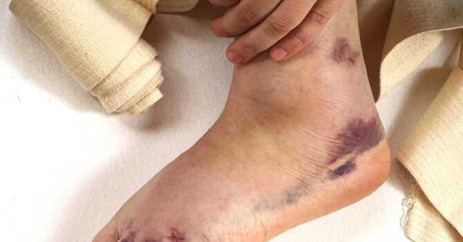 What to do after an ankle sprain image